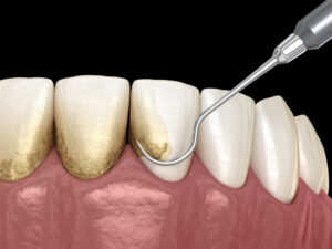 periodontal therapy Ashley Dental Center dentist in Adelphi, MD