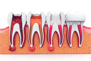 root canal therapy Ashley Dental Center dentist in Adelphi, MD